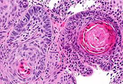 Factor Analysis of Proliferation of Esophageal Squamous Carcinoma Cells