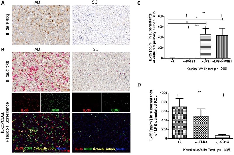 Kupffer cells are one of the cellular sources of IL-35 in liver cirrhosis