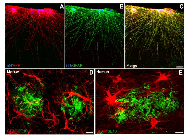 Astrocytes, Brain Injuries and Alzheimer’s Disease