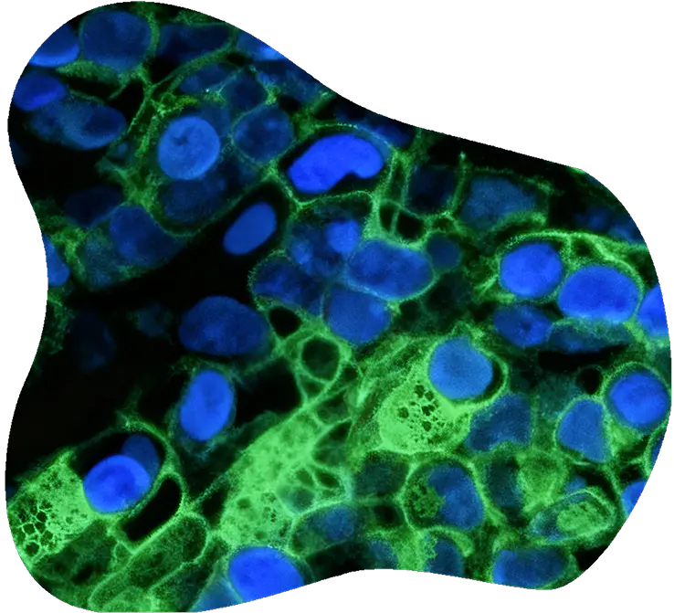 Fluorescence-stained cancer cells for precision oncology research.